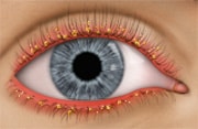 blepharitis